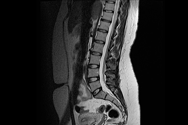 Что показывает МРТ грудного отдела позвоночника